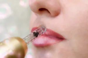 Mesotherapy for the Face and Lips Using Hyaluron Pen
