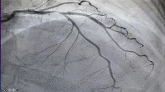 Coronary Angiography with MCQs and notes